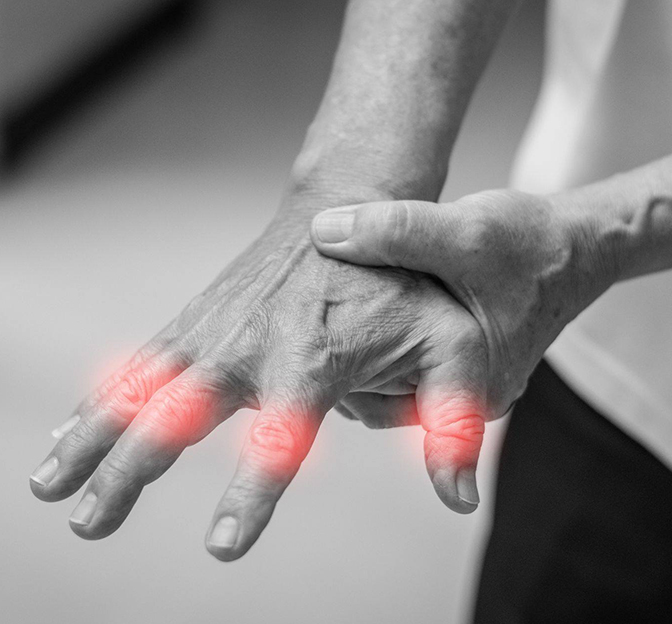 Arthritis of Hand