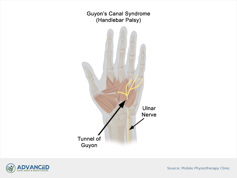 Guyon's canal syndrome