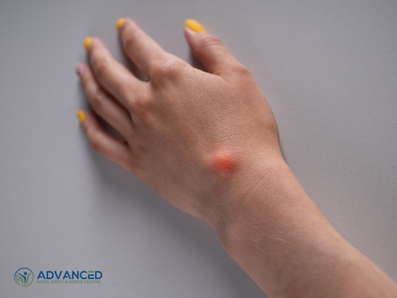 Ganglion cysts will not go away